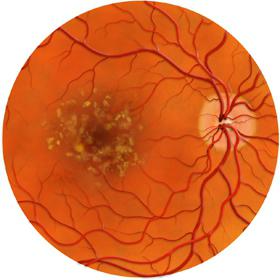 distrofia retinica