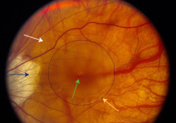 хориоретинална дистрофия на ретината