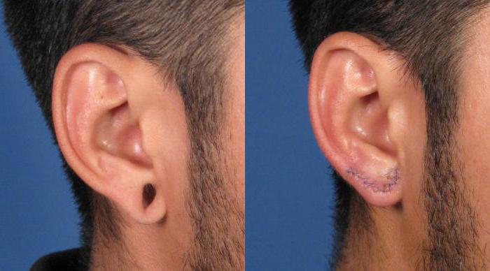 Направите пластично ухо