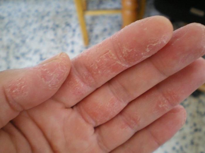 eczema secco sulle mani