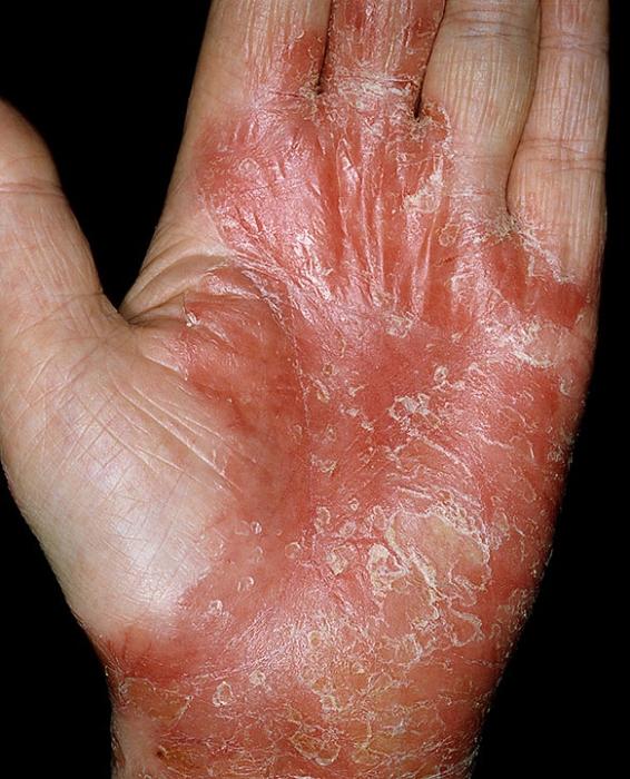 eczema secco sul trattamento delle mani