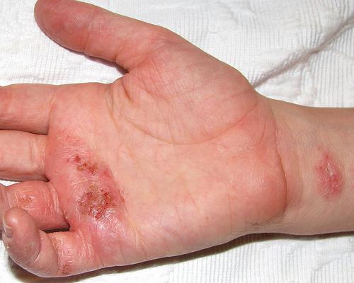 rimedi popolari per il trattamento dell'eczema varicoso
