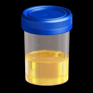 povečanje beljakovin v urinu