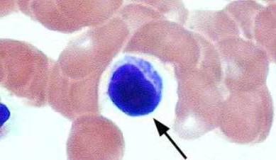 Povišene bijele krvne stanice u razmazu tijekom trudnoće