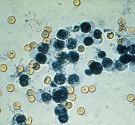 Bele krvne celice v blatu