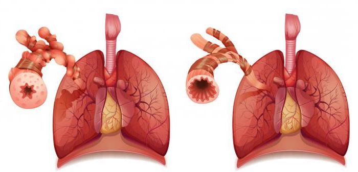 léčba bronchiálního astmatu u dospělých