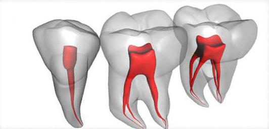 endodontická léčba
