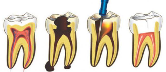 zdravljenje zobnih kanalov