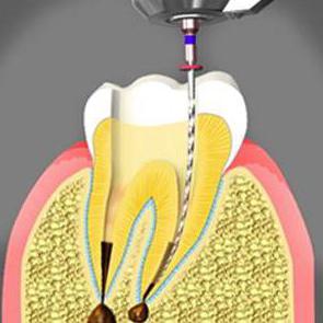 cilje endodontskega zdravljenja