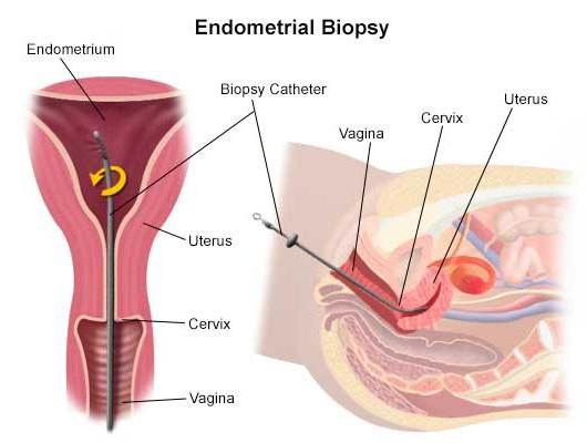 ревюта на ефектите на биопсия на ендометриума