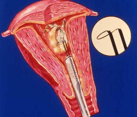 hiperplazija endometrija s klimaksom, pregledi krpanja