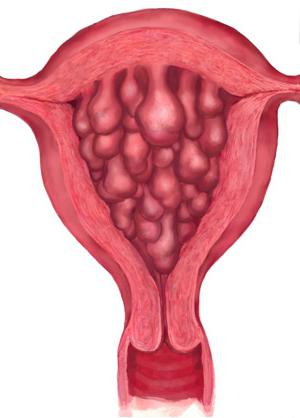 simptomi hiperplazije endometrija