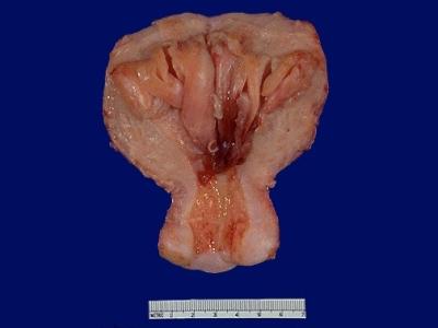 Endometriální hyperplazie
