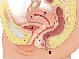 Vzroki za hiperplazijo endometrija