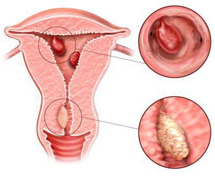 polipoza endometrija