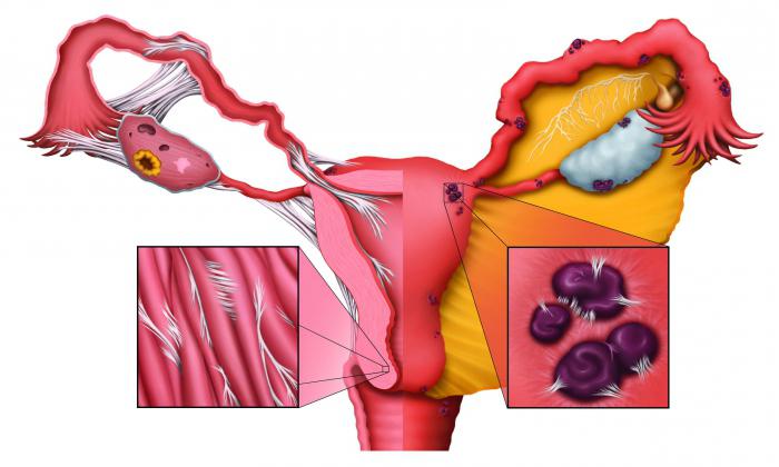 ендометриоза на матката