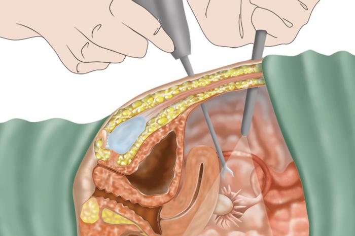 operace endometriózy