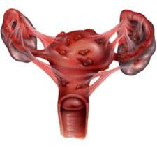 endometriosi: sintomi e trattamento