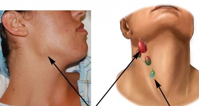 otečene limfne čvorove u vratu