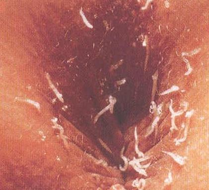 zdravljenje pinwormov z ljudskimi zdravili