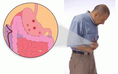 simptomi erozivnega gastritisa