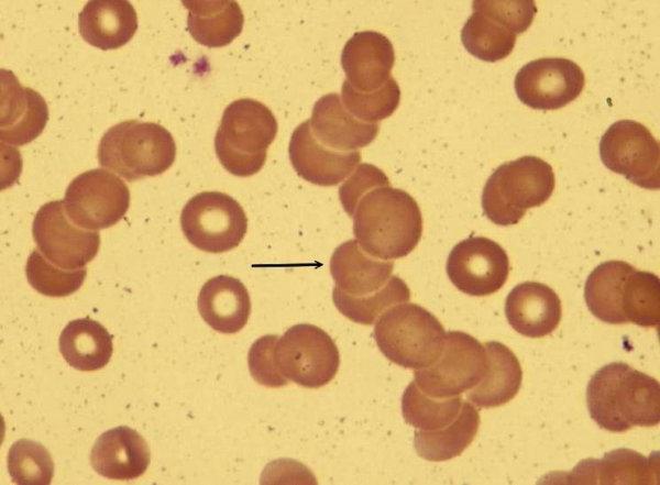 tasso di sedimentazione dell'eritrocito