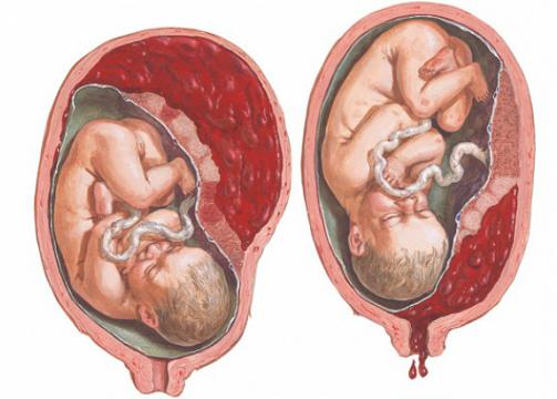 scarico precoce della placenta