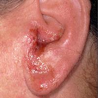 objawy zapalenia ucha