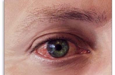 trattamento di infiammazione oculare