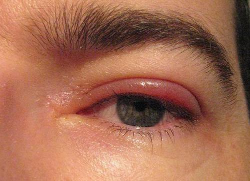 léčba očních víček