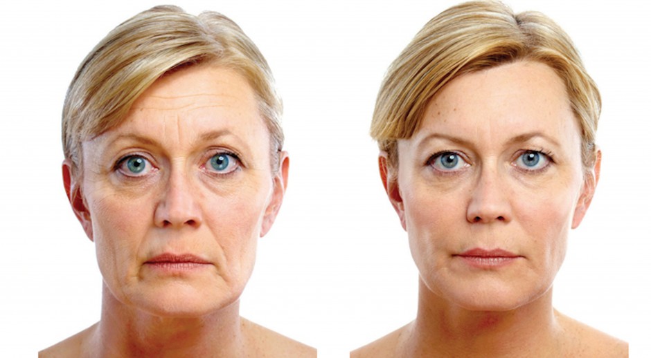 Био-подсилващо лице преди и след