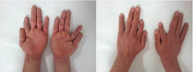 artroza obrada rubova