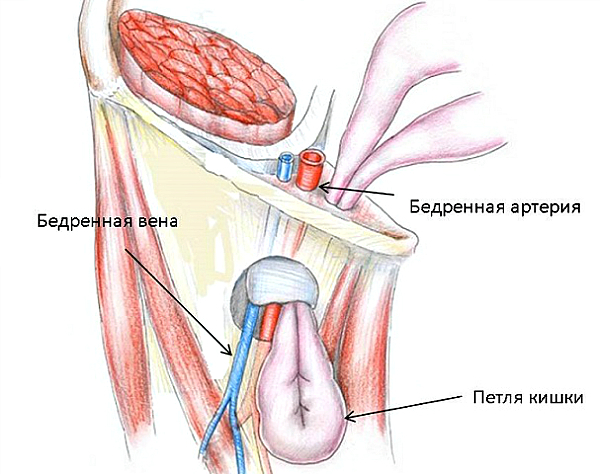 femoral hernia repair