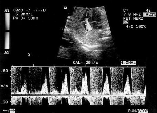 dopplerografii během těhotenství