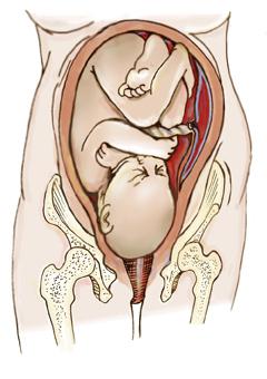 Fetal position longitudinal previa head photo