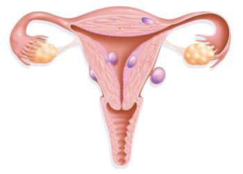 fibroma uterino che cos'è