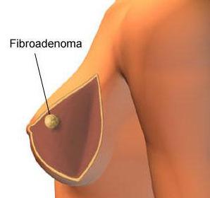 fibroma kaj je to fotografija