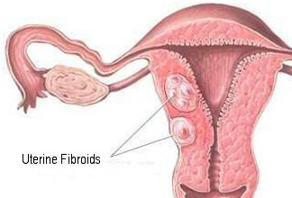 fibroma ovarico di cosa si tratta