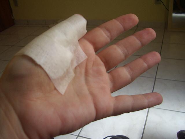 Увреждане на палеца