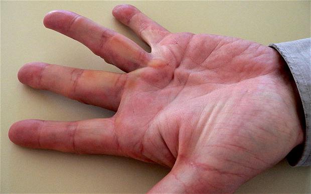десният пръст на дясната ръка нараства
