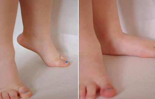 sintomi del flatfoot