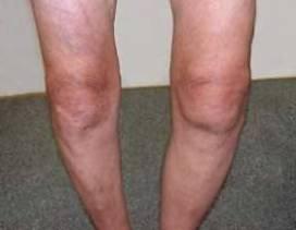 tekućine u liječenju zglobova koljena