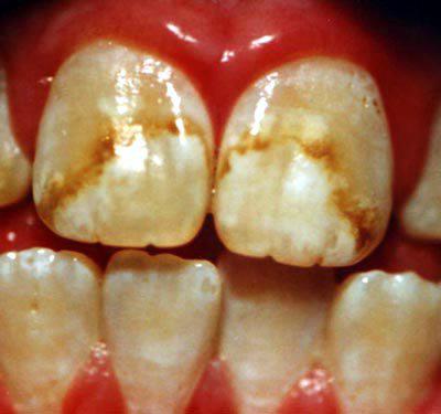 pregled fluoridacije zuba