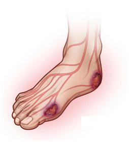 sintomi del piede diabetico