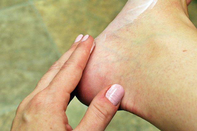 hiperkeratoza dlani in stopal