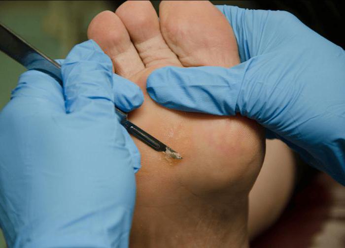 come trattare l'ipercheratosi del piede