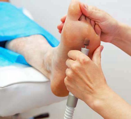 trattamento di ipercheratosi ai piedi