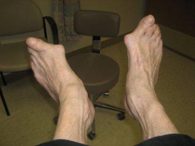 bolest v kloubech nohou