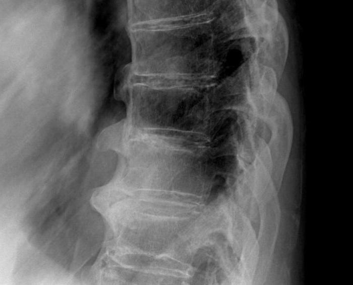 Рентгенова картина на болестта Forestier