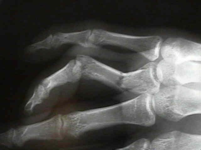 Открытый перелом фаланги. Перелом диафиза основной фаланги. Перелом фаланги кисти рентген. Перелом фаланги мизинца рентген. Краевой оскольчатый перелом пальца руки.